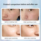 Dotting Mole Pen Nevus Removal Tool Spot Remover Red Blue Light Therapy Beauty